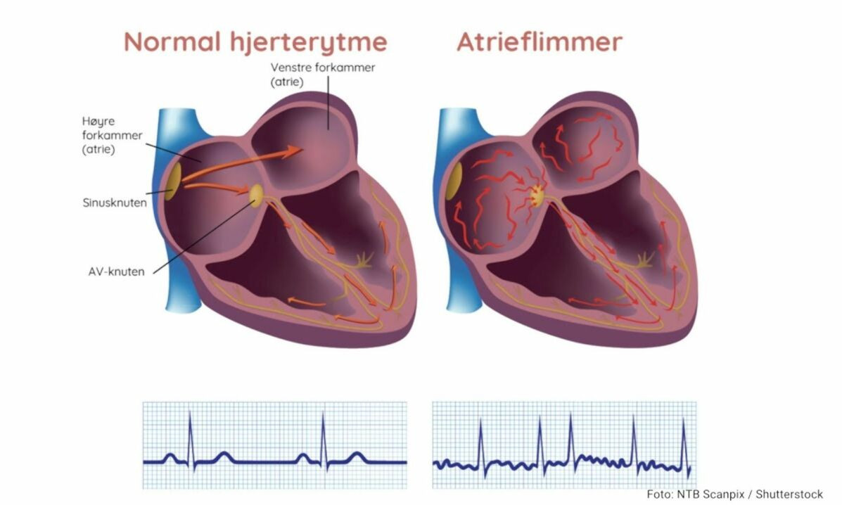 Atrieflimmer